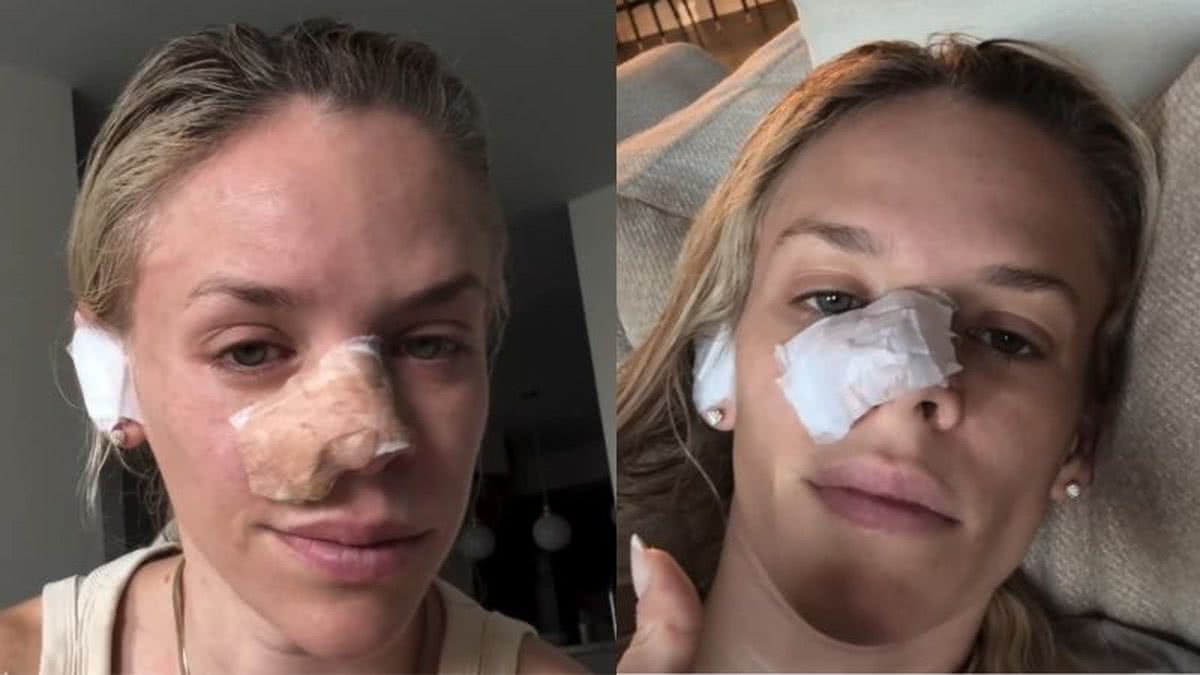 Apresentadora de TV descobre câncer após confundir tumor com espinha que não sumia