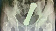 Raio-X de bacia com peso de academia - Reprodução/ International Journal of Surgery Case Reports