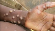 Reprodução / Nigeria Centre for Disease Control