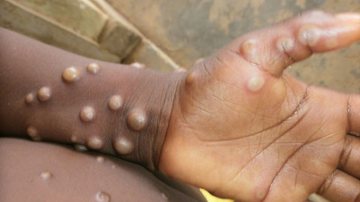 Foto: Reprodução /  Nigeria Centre for Disease Control