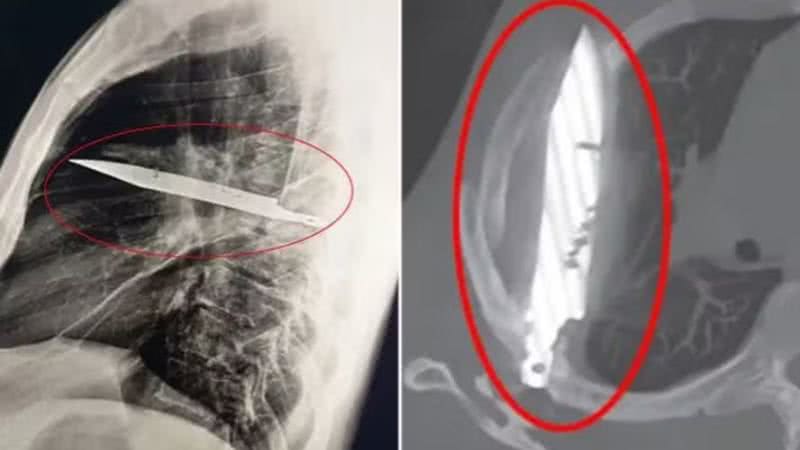 Reprodução/Journal of Surgical Case Reports
