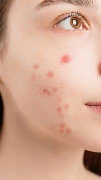 Adeus espinhas! Saiba truques caseiros para eliminar as acnes
