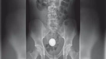 Reprodução/Case Reports in Surgery