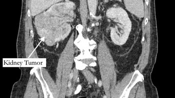 Tomografia de Bernstein mostrando seu tumor no rim. - Foto: Northwell Health/Divulgação