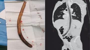 Imagem Homem engole pedaço de madeira de 30cm e justifica: "Vozes na cabeça"