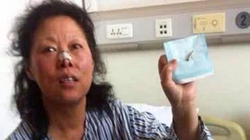 Imagem Mulher tem bala retirada da cabeça após levar um tiro há 48 anos