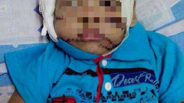 Imagem Criança é atacada por pitbull e tem rosto desfigurado