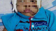 Imagem Criança é atacada por pitbull e tem rosto desfigurado