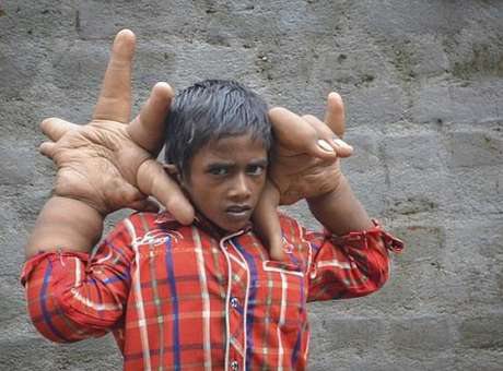 Imagem Indiano tem mãos gigantes de 33 centímetros e 16 quilos