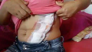 Imagem Jovem leva 35 pontos na barriga após queda de camarote em show do Jammil