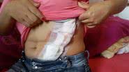 Imagem Jovem leva 35 pontos na barriga após queda de camarote em show do Jammil
