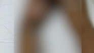 Imagem Menina cai sentada em fogueira e tem queimaduras de 3º grau