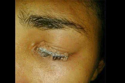 Imagem Mulher cola um dos olhos com super-bonder tentando pôr cílios postiços