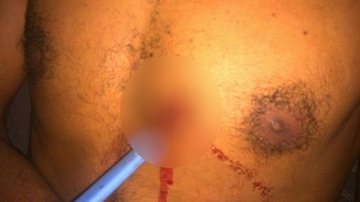 Imagem  Jovem fica 24 horas com faca cravada no peito após briga em SC