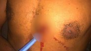 Imagem  Jovem fica 24 horas com faca cravada no peito após briga em SC
