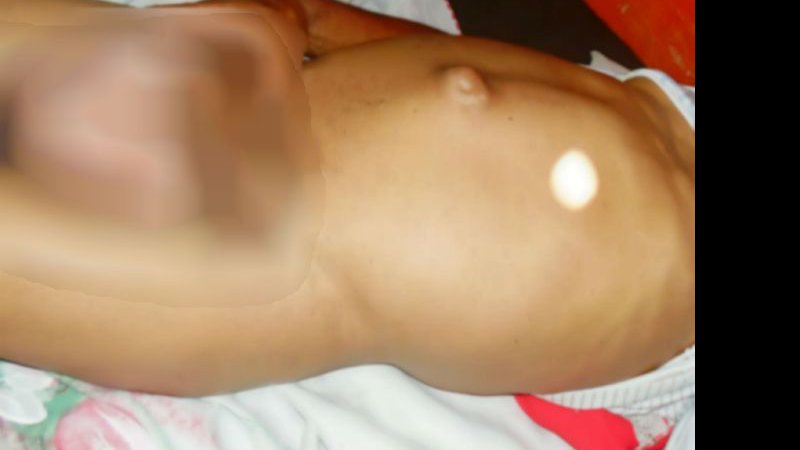 Imagem Descaso na saúde: lavrador com líquido nos testículos sofre em Piritiba