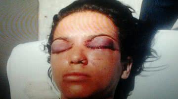 Imagem Ex-companheiro fura os olhos de mulher após tortura