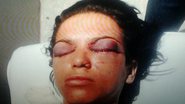 Imagem Ex-companheiro fura os olhos de mulher após tortura