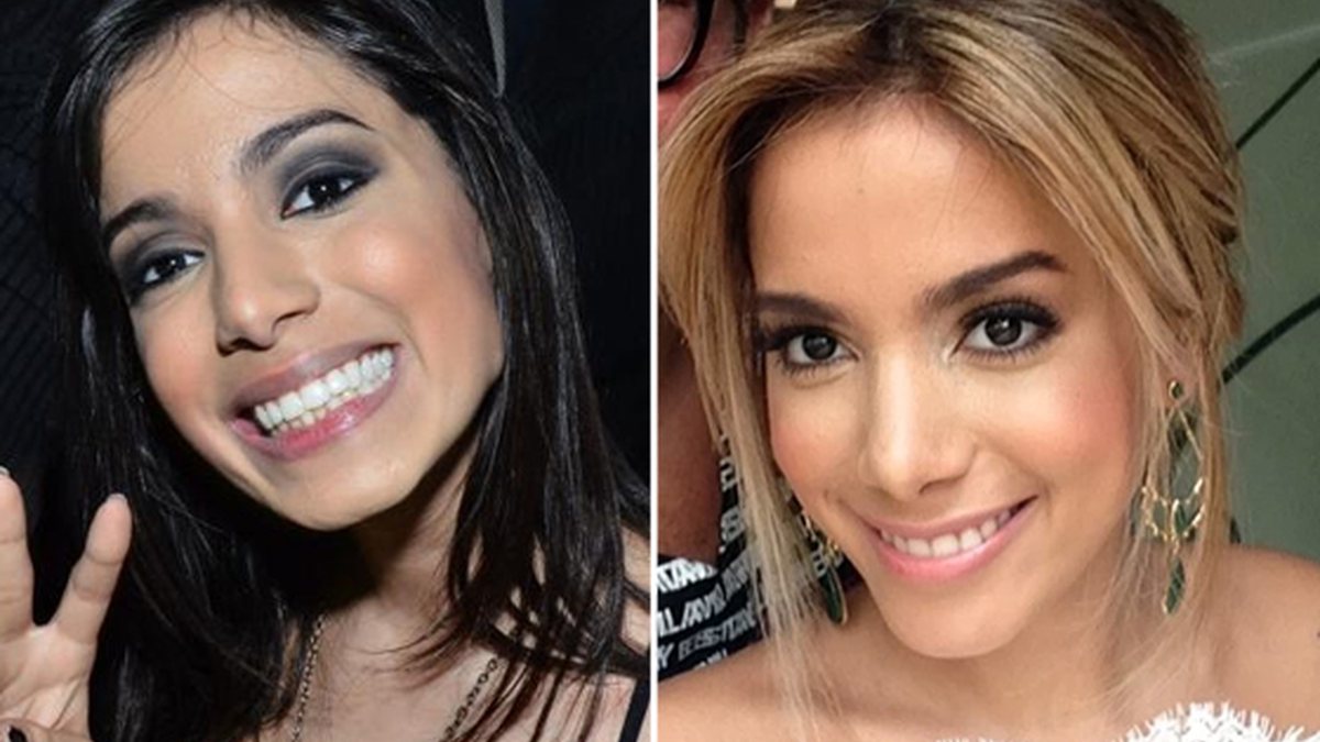 Veja foto de Anitta antes e depois de plástica no nariz