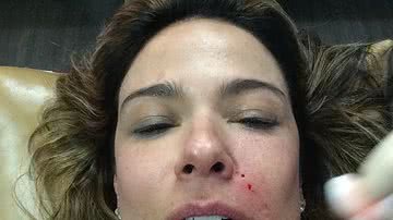 Imagem Luciana Gimenez faz tratamento com sangue. Assista