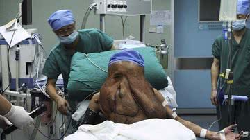 Imagem “Homem elefante” retira tumor de 15 quilos do rosto