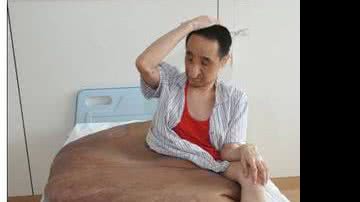Imagem Homem tem maior tumor do mundo com 110 kg removido em cirurgia