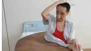 Imagem Homem tem maior tumor do mundo com 110 kg removido em cirurgia