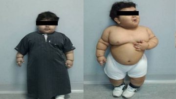 Imagem Bebê obeso é o mais jovem a operar barriga
