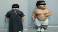 Imagem Bebê obeso é o mais jovem a operar barriga