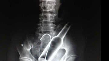 Imagem Homem é operado após inserir garrafa no ânus e tentar retirar com arame