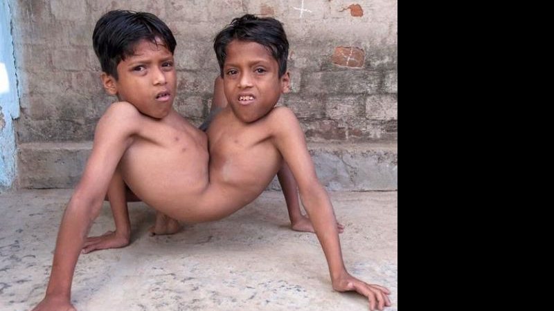 Imagem Indianos adoram gêmeos siameses como encarnação divina