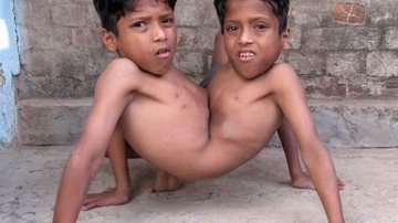 Imagem Indianos adoram gêmeos siameses como encarnação divina