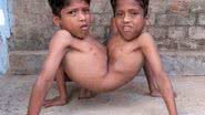Imagem Indianos adoram gêmeos siameses como encarnação divina