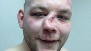 Imagem Lutador exibe nariz desfigurado após combate de MMA