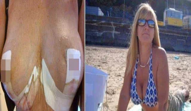 Imagem Mulher investe R$ 12 mil em cirurgia plástica e silicone explode 