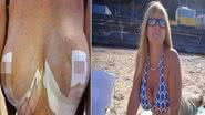 Imagem Mulher investe R$ 12 mil em cirurgia plástica e silicone explode 