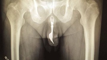 Imagem  Idoso passa por cirurgia após introduzir garfo no pênis em ato sexual