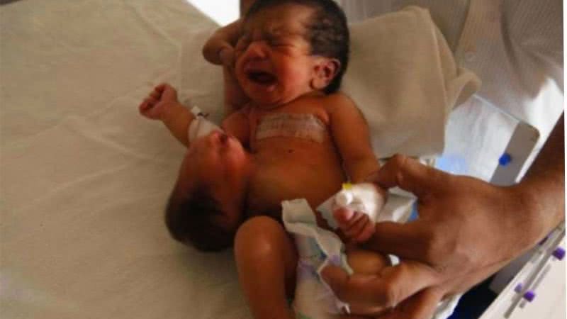 Imagem Bebê nasce com cabeça ligada a estômago