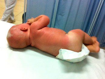 Imagem Bebê de cinco meses é internado com graves queimaduras de sol
