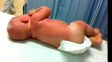 Imagem Bebê de cinco meses é internado com graves queimaduras de sol