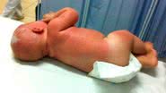 Imagem Bebê de cinco meses é internado com graves queimaduras de sol