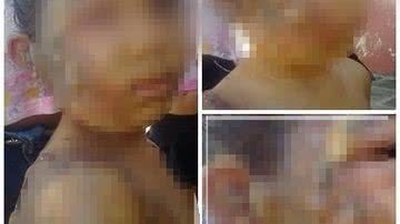 Imagem Padrasto queima enteada de quatro anos com panela quente 