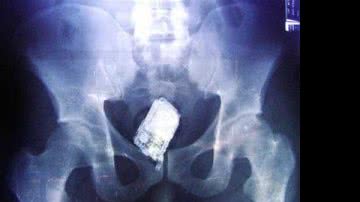 Imagem Pistola e celular são encontrados dentro do ânus de presidiário de Itabuna