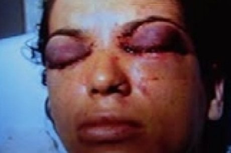 Imagem Mulher que teve os olhos perfurados está com depressão e pesando 40kg