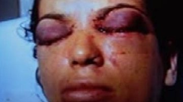 Imagem Mulher que teve os olhos perfurados está com depressão e pesando 40kg
