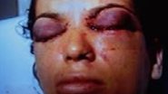 Imagem Mulher que teve os olhos perfurados está com depressão e pesando 40kg