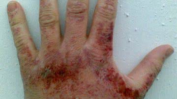 Imagem Mulher queima homem com soda cáustica em Itapuã