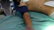 Imagem Bandido tem a mão dilacerada ao tentar explodir caixa do Bradesco
