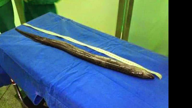 Imagem Assista: homem introduz peixe enguia pelo ânus e médico retira pelo intestino