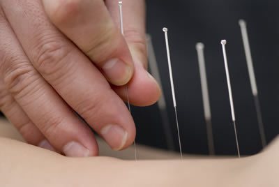 Imagem Psicólogos não podem praticar acupuntura, decide STJ
